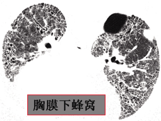 特发性肺纤维化，诊断标准废旧立新