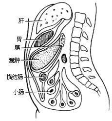 胰假性囊肿切除和内引流术