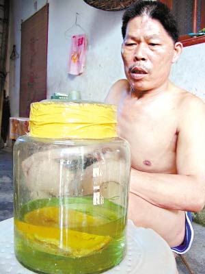 男子无钱手术用酒精浸泡头盖骨三年