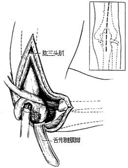 肘关节融合术