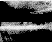 硬膜外腔注射皮质类固醇不能防治硬膜外腔粘连