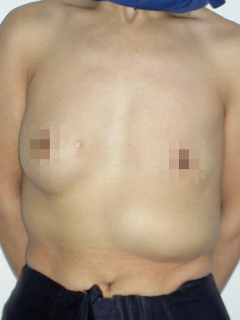 女子隆胸挽救婚姻 整形术失败长出3个乳房
