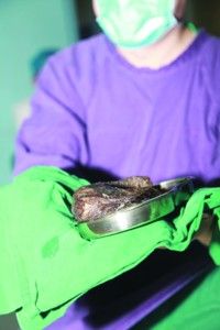 8岁女童患异食癖喜吃头发 开腹取出1斤头发