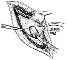 肾切除术
