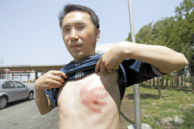 男子胸前现血色手印 医生称难判断具体病情