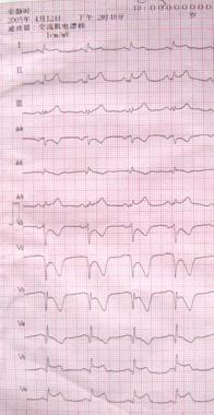 LAD LCX均闭塞的急性心肌梗死成功PCI