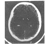 结节性硬化症三家系11例分析