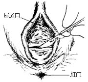 阴道成形术