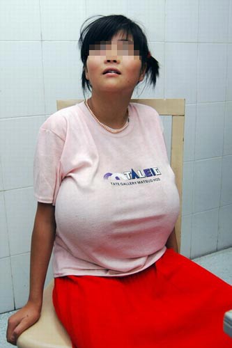 12岁女孩双乳竟然长到足球大小图