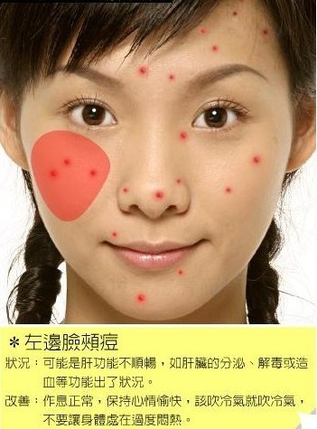 通过脸上痘痘位置看你的健康状况