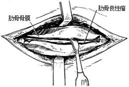 肋骨肿瘤切除术