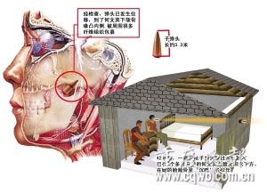 子弹射入女子右脸42年后被取出