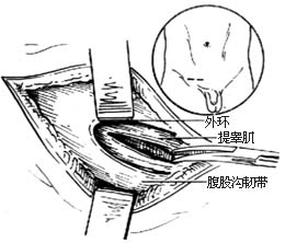 小儿腹股沟斜疝修复术