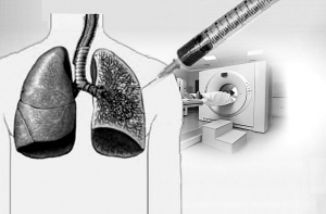 利用微创靶向综合疗法破解难治性肺结核治疗的世界难题