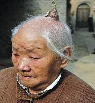 93岁老人头顶长出10厘米长犄角