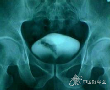 科普：揭开膀胱癌细胞的“伪装”