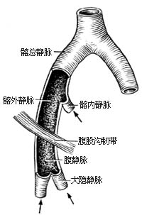 髂、股静脉血栓摘除术