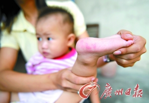 广州接连发现几例疑似手足口病病例