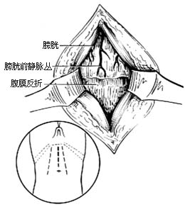 耻骨上膀胱造瘘术