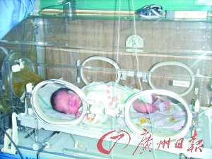 广东重症甲型流感孕妇剖腹产子