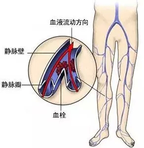 医学科普：静脉曲张是什么回事宜？