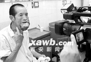 男子患巨舌症30年舌头肿胀如婴儿头大小