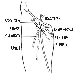大隐静脉高位结扎、剥脱术