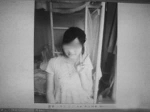17岁少女接受药物治疗后长胡子