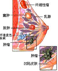 乳房自检：看触卧拧