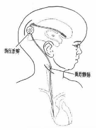 先天性脑积水