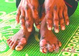 越南现神秘皮肤病 数百人手脚感染死亡率高