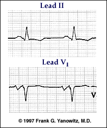 左房扩大 left atrial enlargement