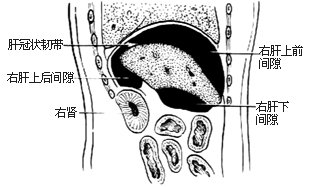 膈下脓肿切开引流术