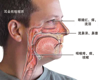 过敏性鼻炎：小毛病 大危害