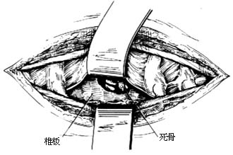 经肋骨、横突切除结核病灶清除术