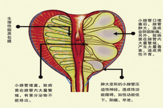 辨证论治前列腺炎