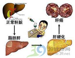 乙肝病人喝酒是雪上加霜