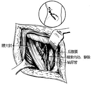 输尿管切开取石术