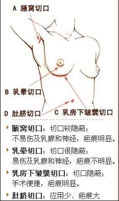 国外隆胸手术全过程实拍