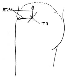 软组织金属异物取出术