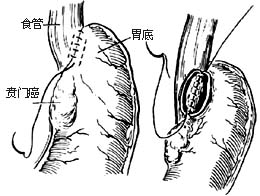 食管癌姑息手术