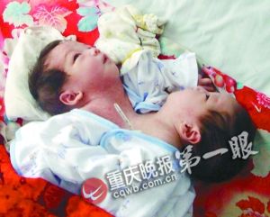 连体女婴作息相反常打架 专家称分离手术难度大