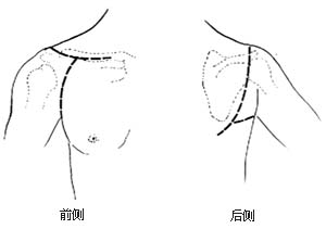 肩胛带截肢术