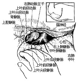 各部位肺切除术