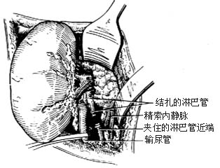 肾蒂淋巴管结扎、肾蒂淋巴管精索内（卵巢）静脉吻合术