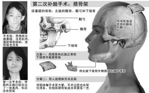 女孩患罕见脸萎缩症将再次取头骨补脸