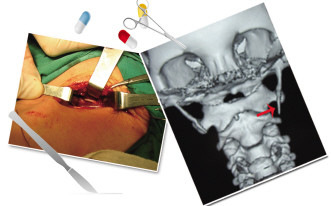 慢性咽痛的不寻常病因