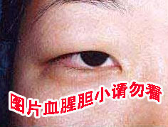 割双眼皮的过程