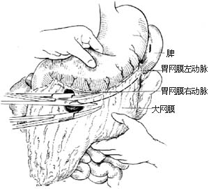胃次全切除胃十二指肠吻合术
