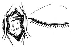 泪小管泪囊鼻腔吻合术